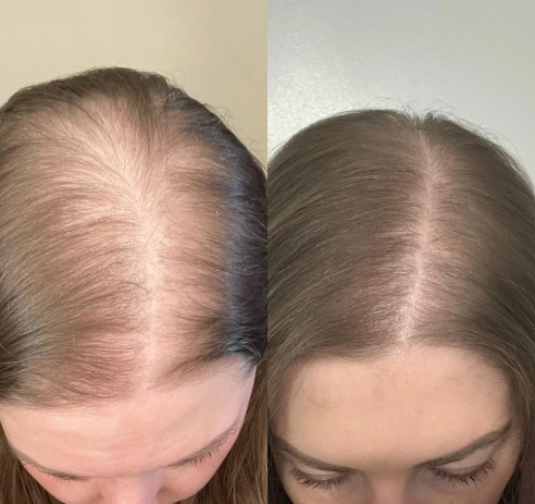 Hair Fall Treatment